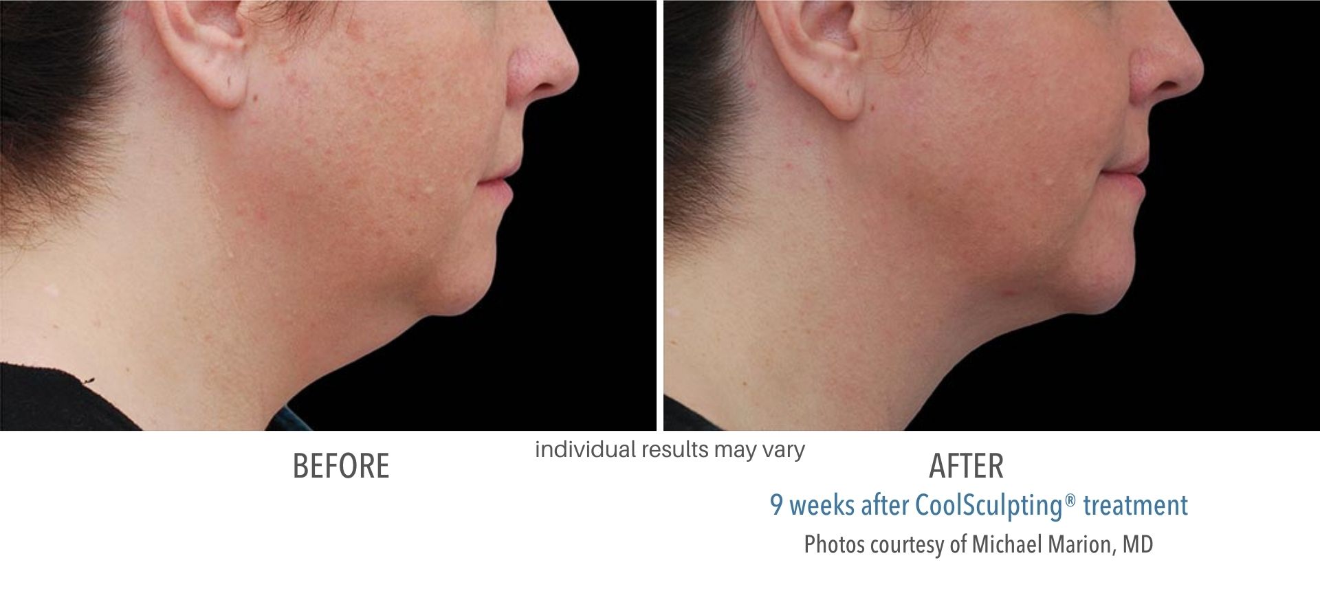 coolsculpting double chin treatment