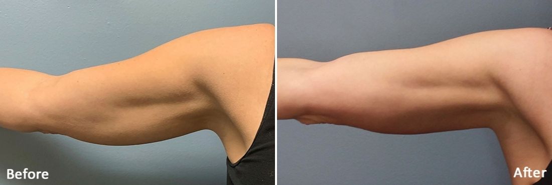 Evolve by INMODE body contouring before and after arms