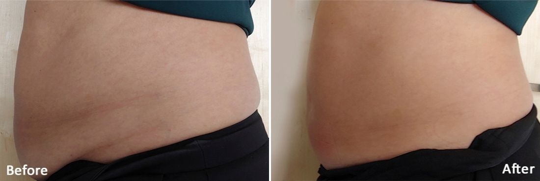 Evolve by INMODE body before and after treatment abdomen