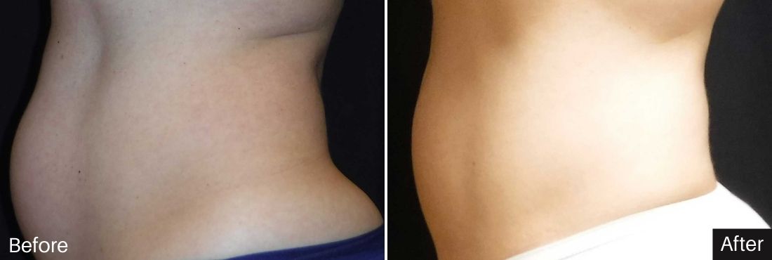 Evolve by INMODE body reshaping abdomen treatment result